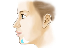 顎-ヒアルロン酸注射