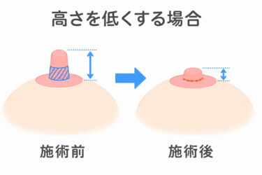 乳頭縮小－高さを低くする場合
