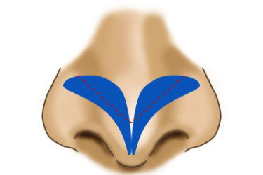 鼻尖縮小術の大鼻翼軟骨の一部切除