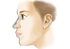 鼻のプチ整形　鼻ヒアルロン酸注入