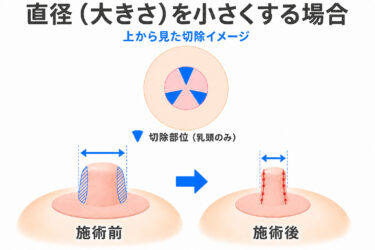 乳頭縮小－直径（大きさ）を小さくする場合