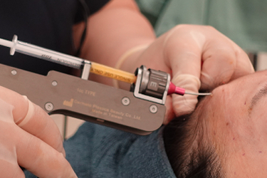 脂肪注入｜CRFの注入