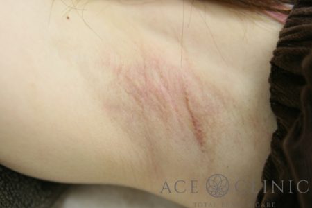 保険適用のわきが手術「反転剪除法」の傷跡の一例