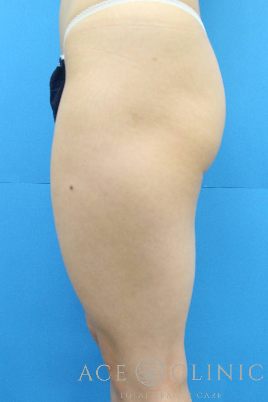 大腿脂肪吸引　左横　術前