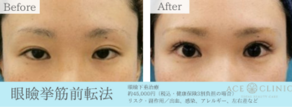 眼瞼下垂手術　32歳女性　症例｜名古屋【エースクリニック】