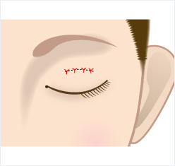 眼瞼挙筋前転法の皮膚縫合