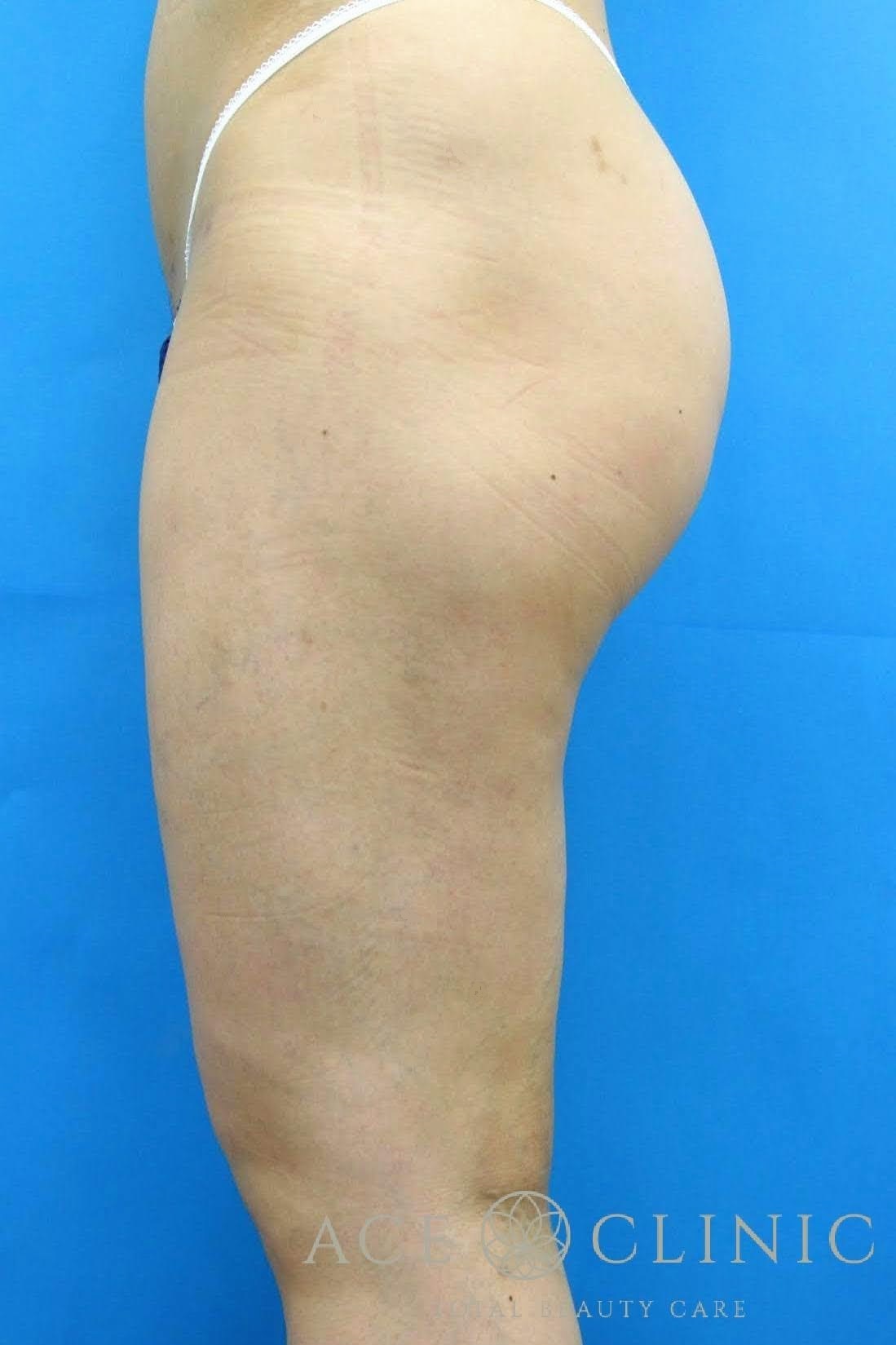 大腿脂肪吸引　症例2　術後3ヶ月　左横｜大阪梅田【エースクリニック】