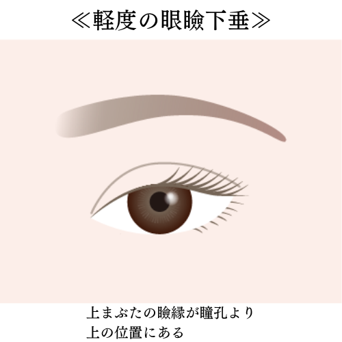 軽度の眼瞼下垂症