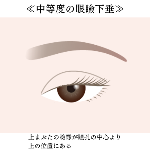 中等度の眼瞼下垂症