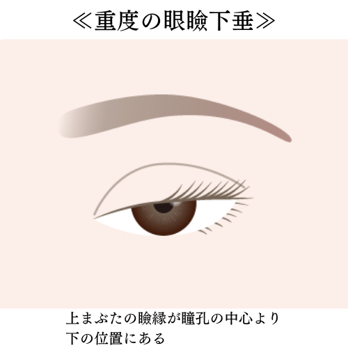 重症の眼瞼下垂症