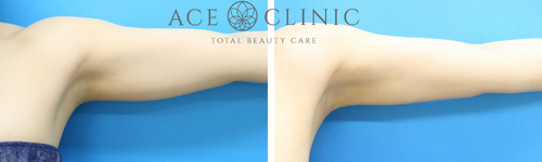 二の腕脂肪吸引モニター_20代女性症例【エースクリニック】名古屋院・大阪梅田院