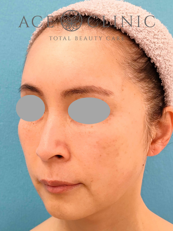 CRF脂肪注入（こめかみ・頬・ほうれい線）｜51歳女性｜症例7｜術後3ヶ月｜左斜め｜名古屋【エースクリニック】