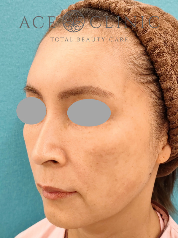 CRF脂肪注入（こめかみ・頬・ほうれい線）｜51歳女性｜症例7｜術前｜左斜め｜名古屋【エースクリニック】