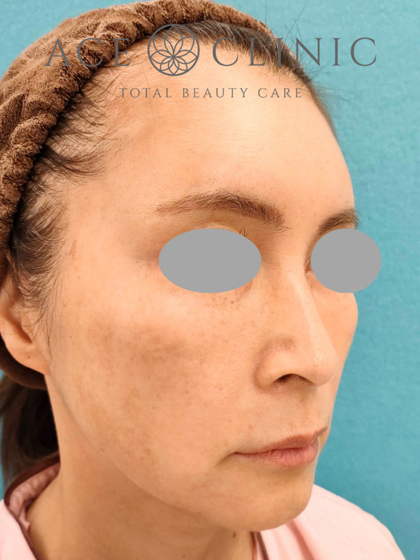 CRF脂肪注入（こめかみ・頬・ほうれい線）｜51歳女性｜症例7｜術前｜右斜め｜名古屋【エースクリニック】