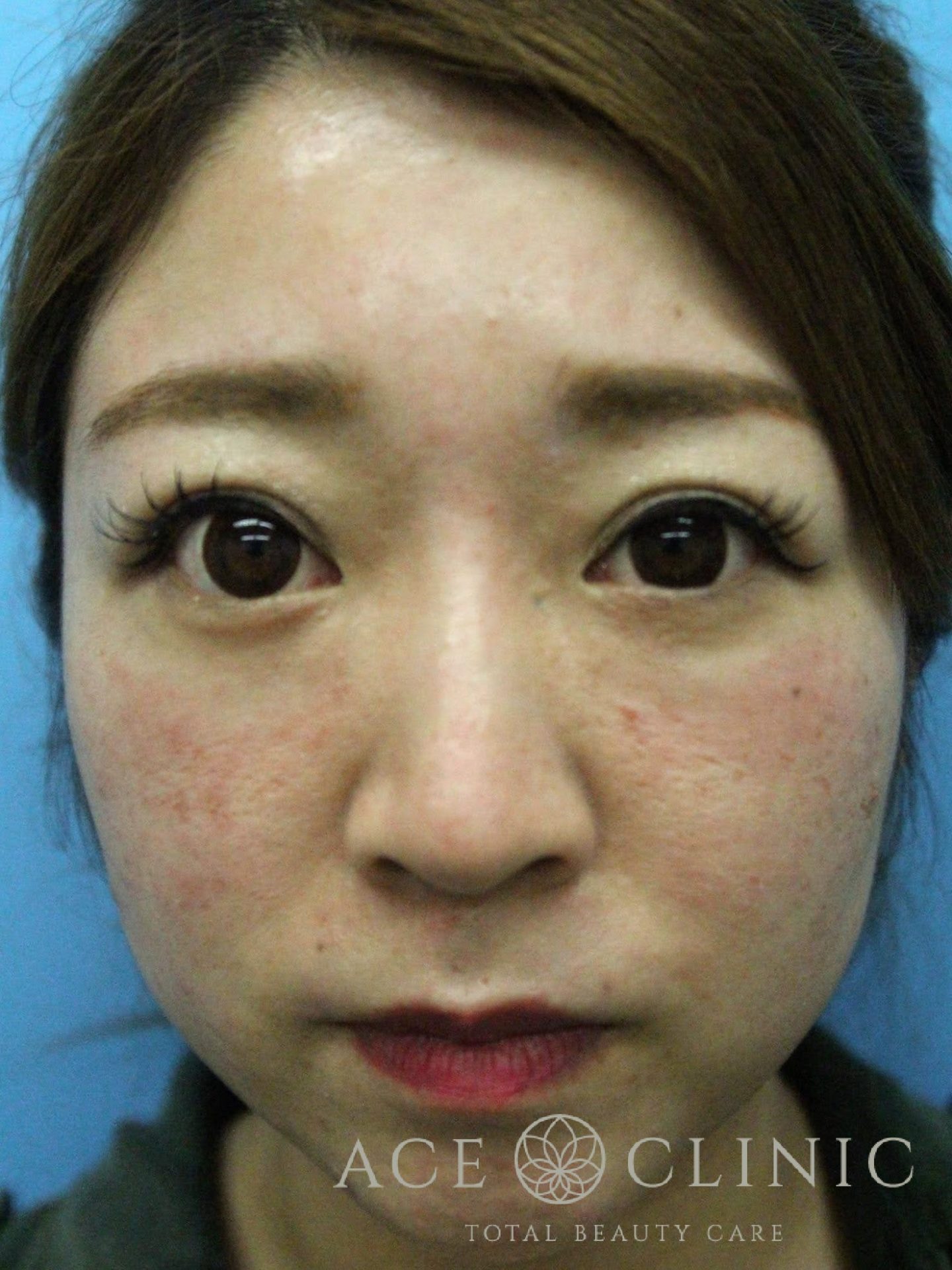 赤ら顔治療（Vビーム2）症例　30代女性　治療前　正面　