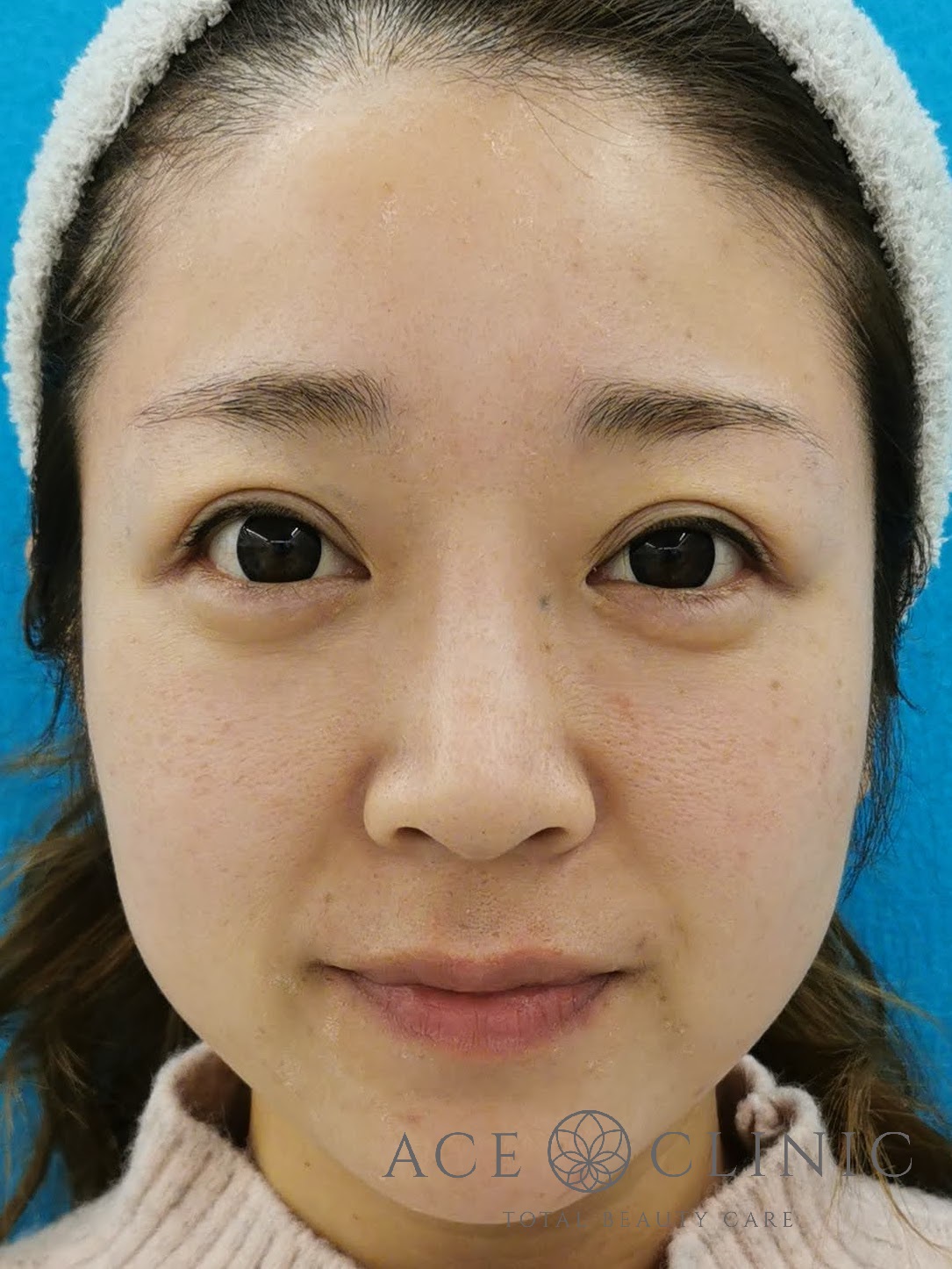 赤ら顔治療（Vビーム2）症例　30代女性　5回照射後　正面