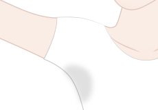 脇の多汗症のイメージ