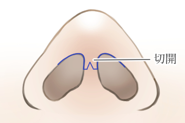 鼻中隔延長術の皮膚切開線（オープン法）