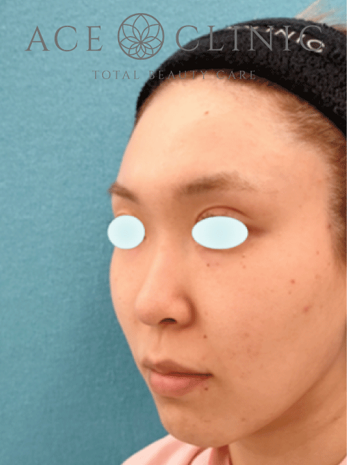 鼻複合手術－鼻中隔延長＋鼻プロテーゼ