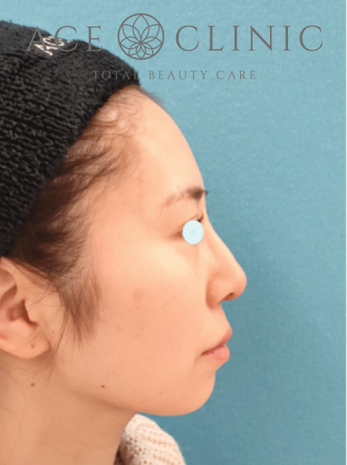 鼻複合手術－鼻中隔延長プロテーゼ症例