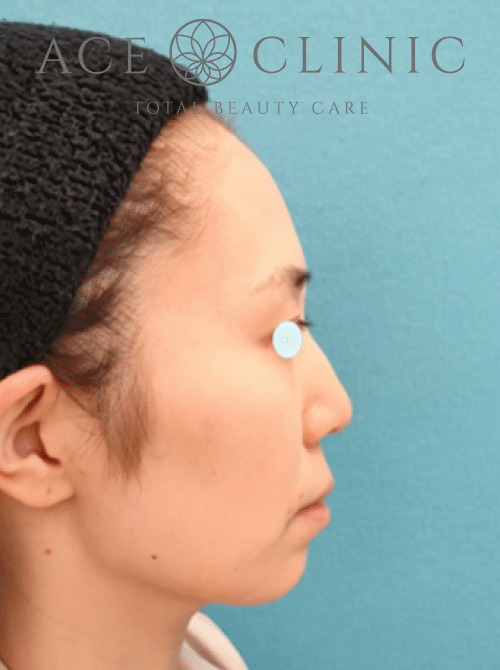 鼻複合手術－鼻中隔延長プロテーゼ症例