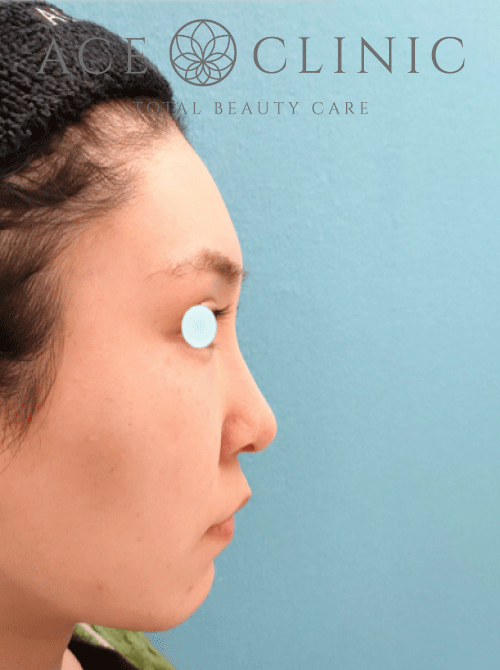 鼻複合手術－鼻中隔延長＋鼻プロテーゼ