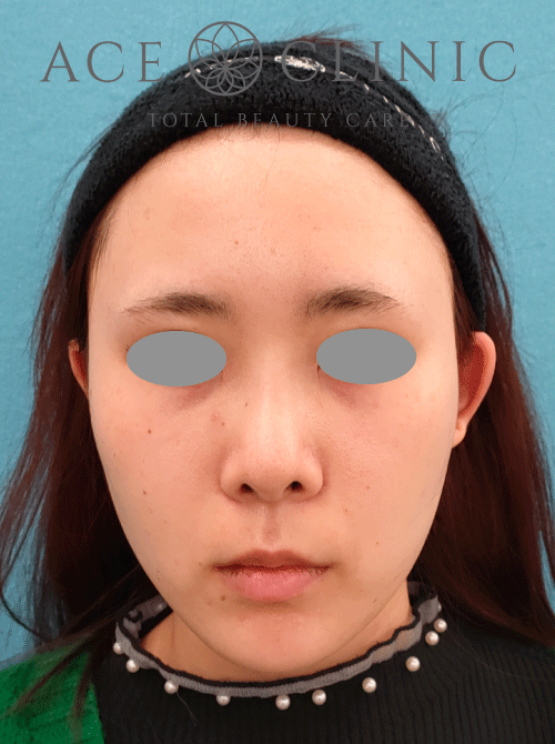 鼻中隔延長｜隆鼻術｜症例7｜27歳女性｜術後2ヶ月｜エースクリニック名古屋院