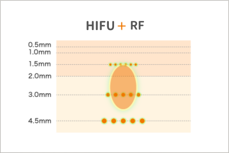 HIFU+RF