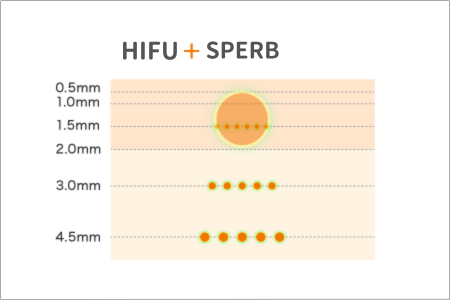 HIFU+SUPERB