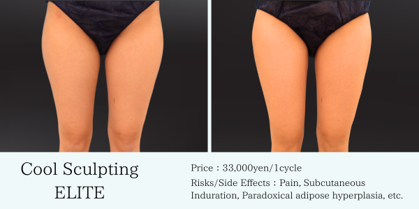 coolsculpting-case-thighs