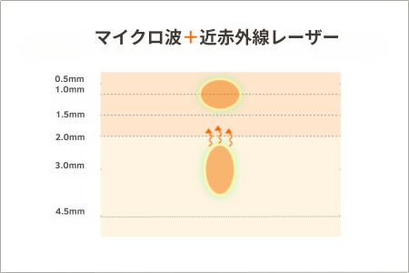 マイクロ波＋近赤外線レーザーの熱の入り方のイメージ