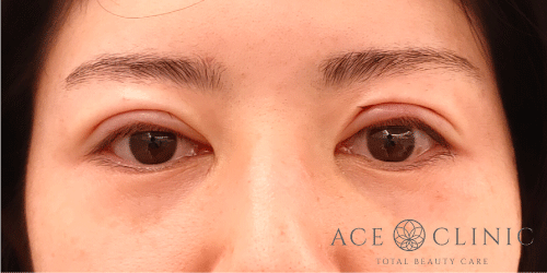 眼瞼挙筋前転法|症例82|女性|術直後|エースクリニック名古屋院