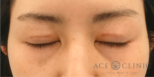 眼瞼挙筋前転法|症例82|女性|術後1ヶ月|閉眼|エースクリニック名古屋院