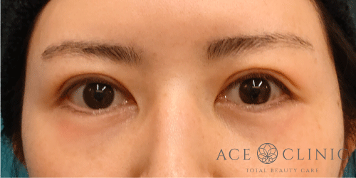眼瞼挙筋前転法|症例82|女性|術後1週間|エースクリニック名古屋院