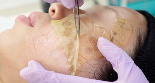 リポットレーザーテープ剥がす