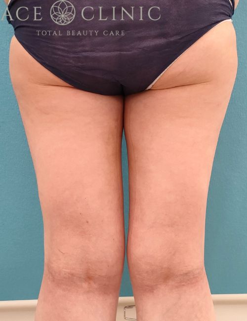 脂肪吸引 （大腿全周＋膝内）｜症例8｜39歳女性｜術後3ヶ月｜エースクリニック名古屋院