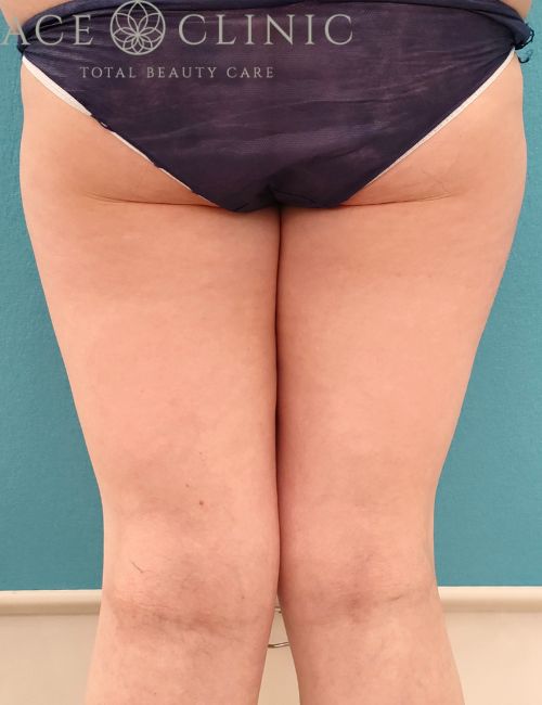 脂肪吸引 （大腿全周＋膝内）｜症例8｜39歳女性｜術前｜エースクリニック名古屋院