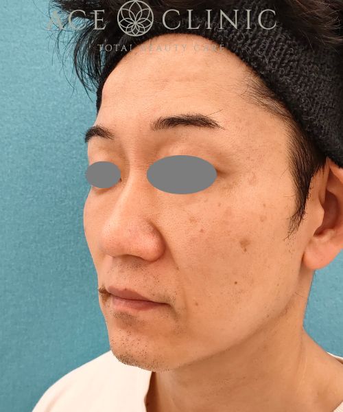 ヒアルロン酸注入｜ボトックスリフト｜症例42｜44歳男性｜術前｜エースクリニック名古屋院