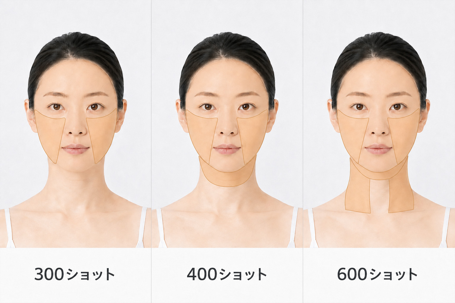 オリジオKISSのショット数による照射範囲の違い