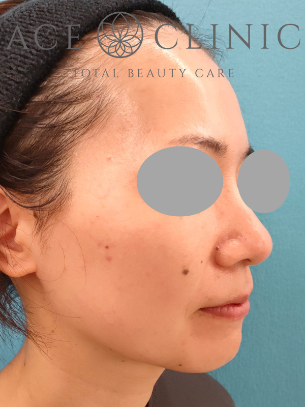 リポットレーザー|症例4|37歳女性|施術後|右斜め|エースクリニック名古屋院