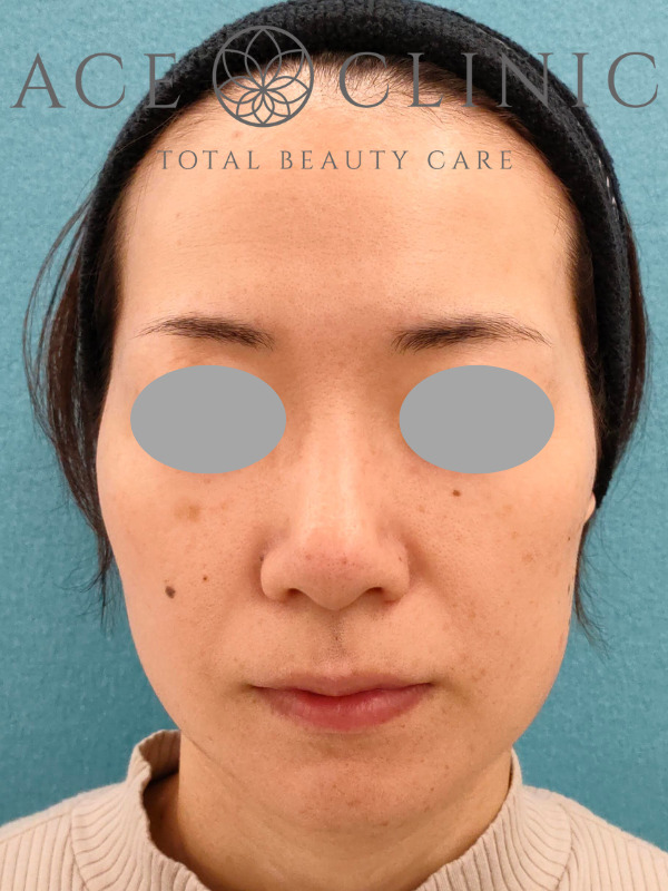 リポットレーザー|症例4|37歳女性|施術前|正面|エースクリニック名古屋院