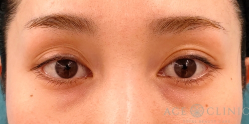 アートメイク除去症例-after