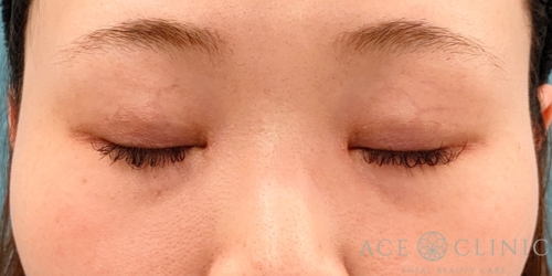 二重埋没|目頭切開|20代女性|症例13|術後|エースクリニック名古屋院