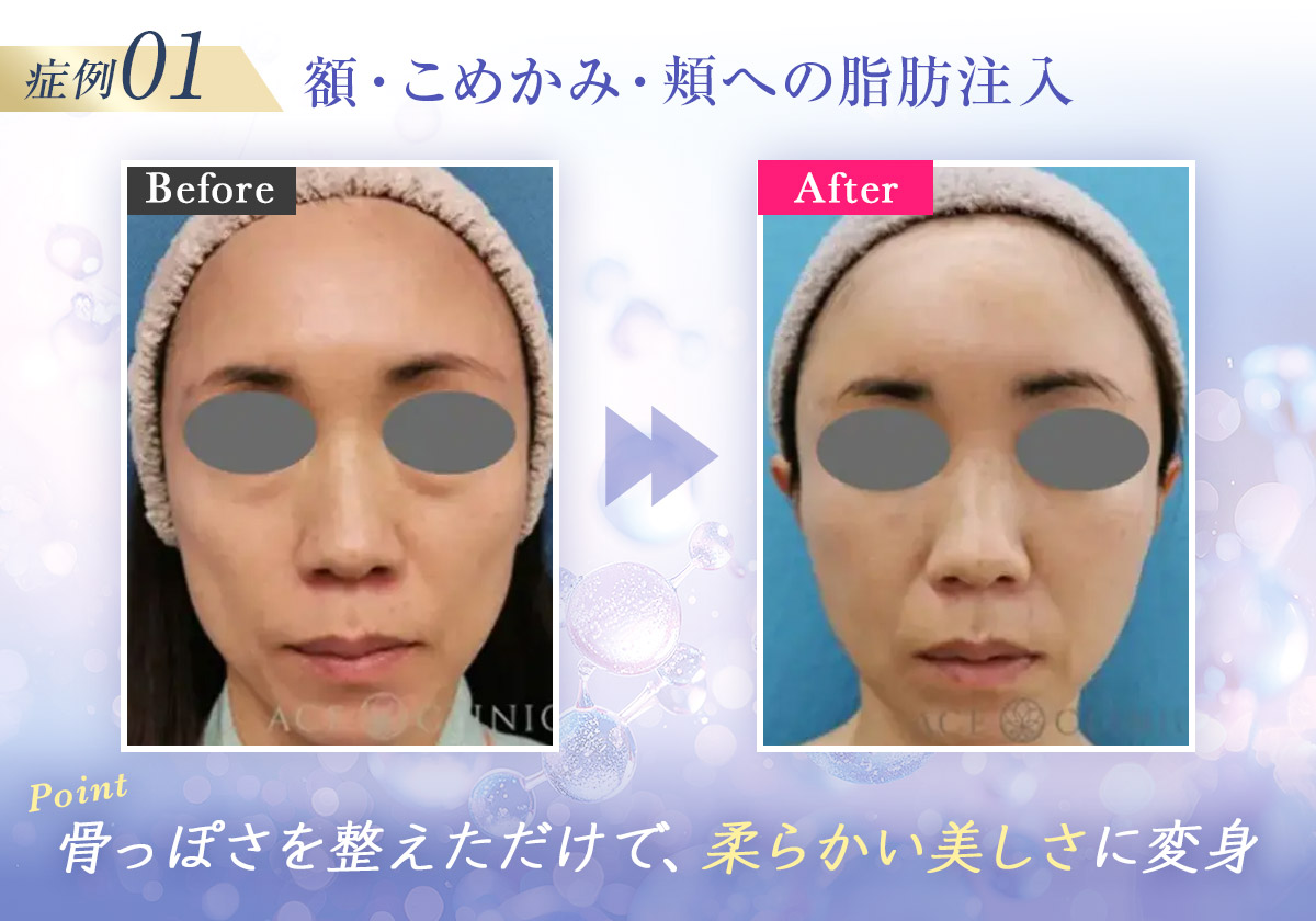 脂肪注入lp-症例