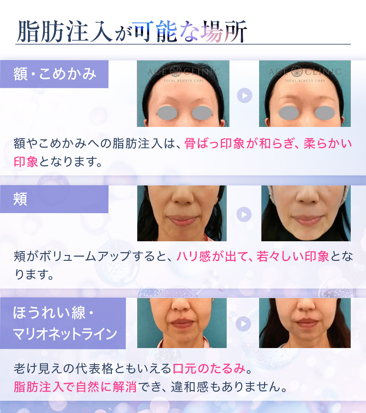 脂肪注入施術可能部位