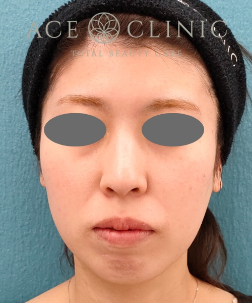 リポットレーザー|症例11|20代女性|術後|エースクリニック名古屋院