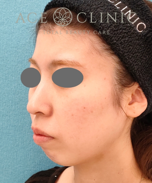 リポットレーザー｜症例11｜20代女性｜術後｜エースクリニック名古屋院