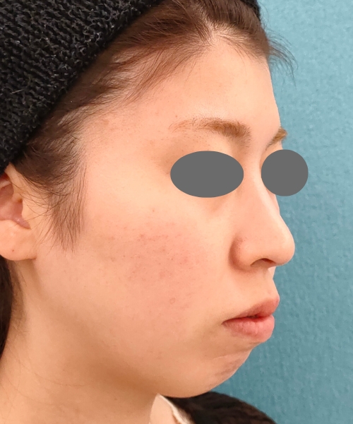 リポットレーザー｜症例11｜20代女性｜術後｜エースクリニック名古屋院