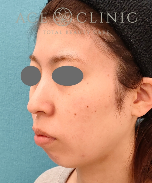 リポットレーザー｜症例11｜20代女性｜術前｜エースクリニック名古屋院