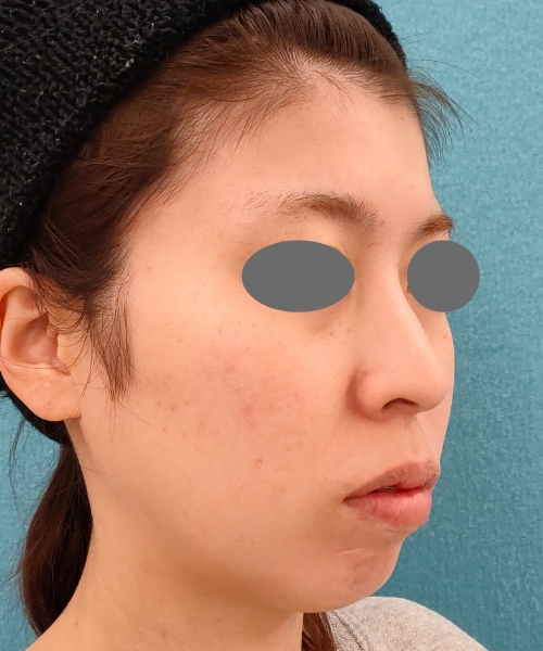 リポットレーザー｜症例11｜20代女性｜術前｜エースクリニック名古屋院